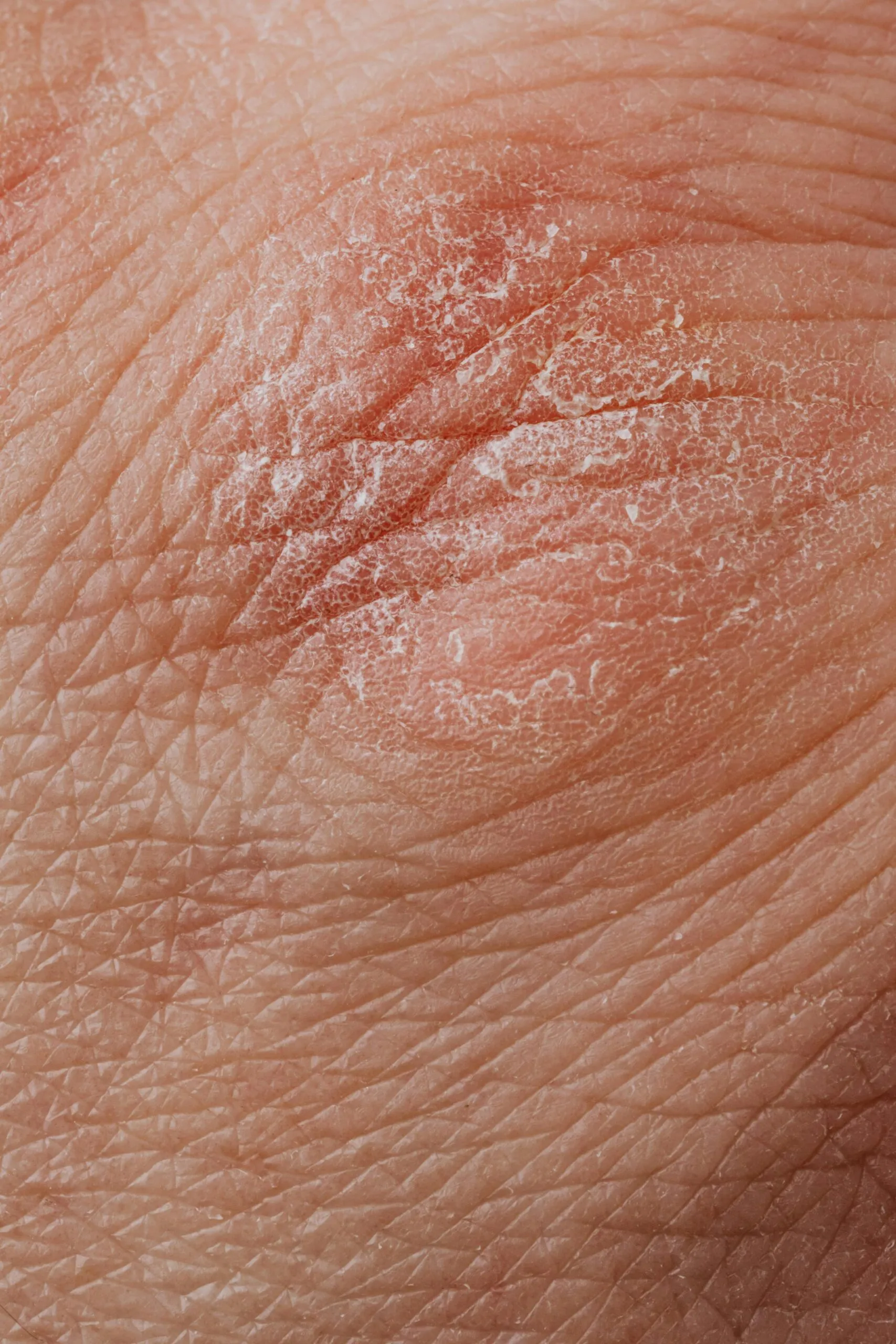 How to Combat Dry Skin: Medical and Skincare Solutions